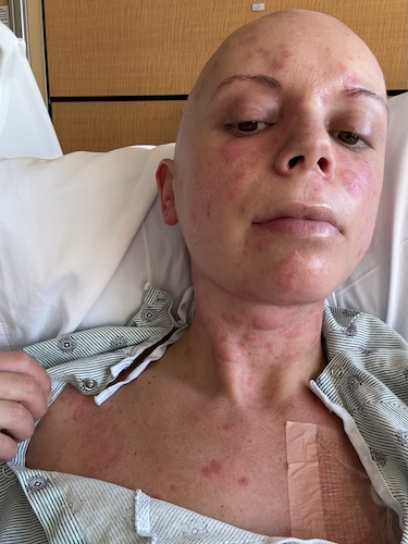 Kacie K. ovarian cancer