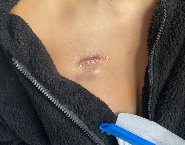 McKenna A. synovial sarcoma