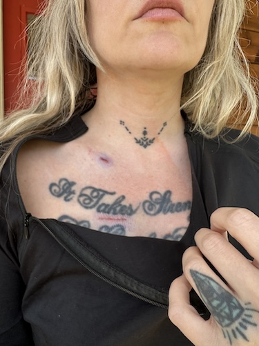 Nicole B. triple-negative breast cancer