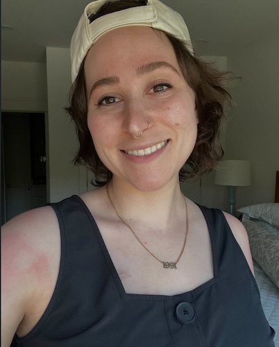 Sophie F. Ewing sarcoma