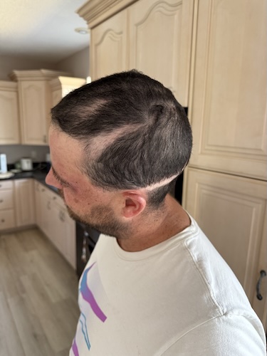 Stephen S. lacrimal gland cancer