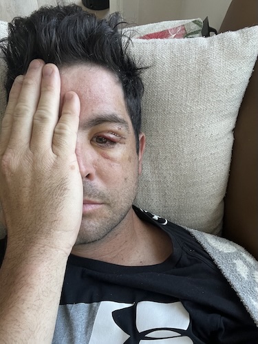 Stephen S. lacrimal gland cancer