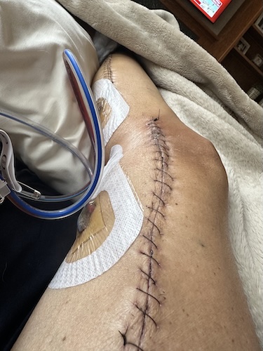 Tammy U. metastatic breast cancer