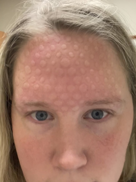 Ali C. adenoid cystic carcinoma