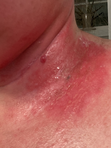 Ali C. adenoid cystic carcinoma