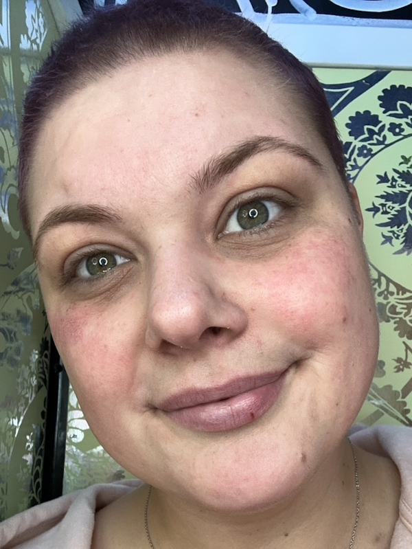 Ashley P. stage 4 DLBCL