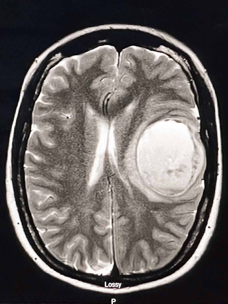 Caroline W. grade 4 glioblastoma