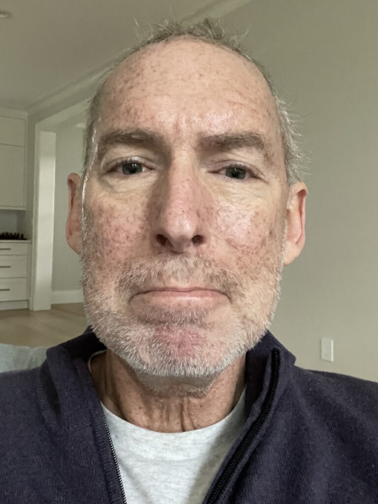 Dr. Ross Camidge stage 4 lung cancer