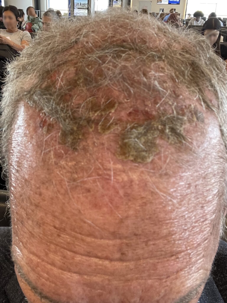 Dr. Ross Camidge stage 4 lung cancer