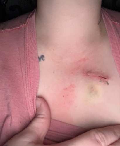 Macy L. cervical cancer