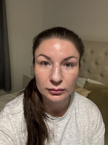 Vikki F. nasal squamous cell carcinoma