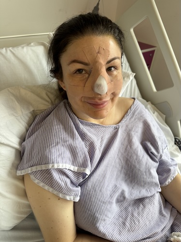 Vikki F. nasal squamous cell carcinoma