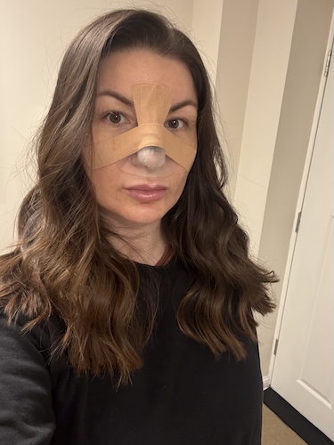 Vikki F. nasal squamous cell carcinoma