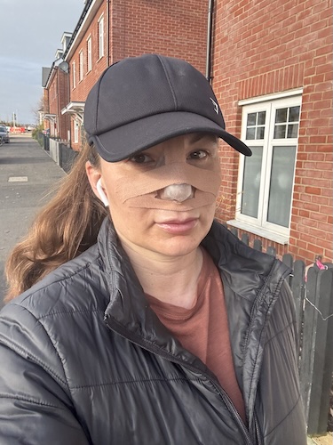 Vikki F. nasal squamous cell carcinoma