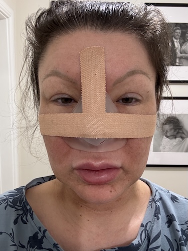 Vikki F. nasal squamous cell carcinoma