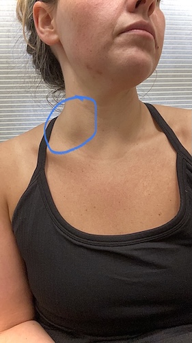 Sarah K Hodgkin lymphoma