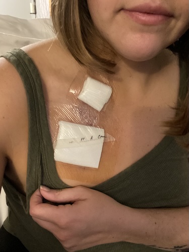 Sarah K Hodgkin lymphoma