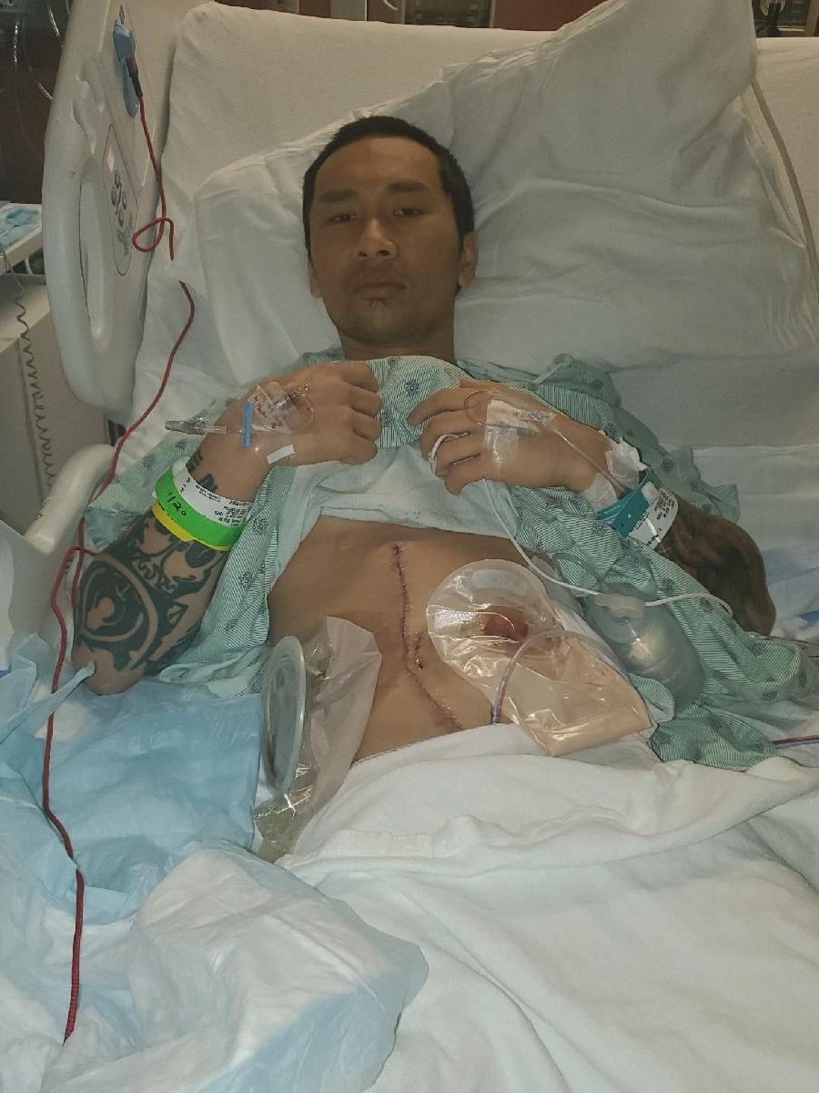 Bill T. rectal neuroendocrine carcinoma