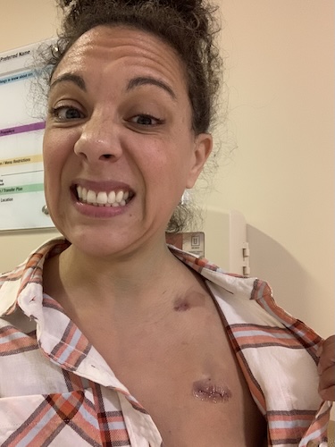 Nicole F. DCIS breast cancer