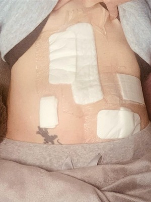 Nina H. stage 4 bowel cancer