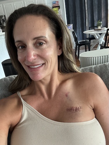 Sarah G. rectal cancer