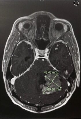 Michael Bugary brain cancer