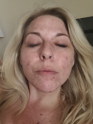 Alicia S. pancreatic neuroendocrine cancer