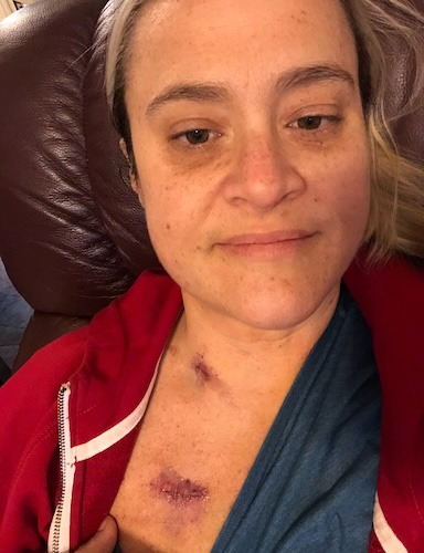 Kristen B. colon cancer