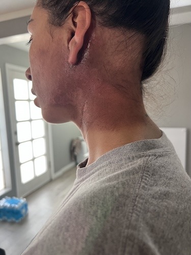 Selina P. parotid cancer