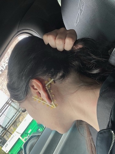 Selina P. parotid cancer