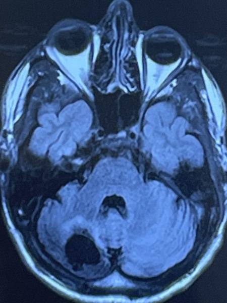 Jake L. stage 4 ALK-positive lung cancer