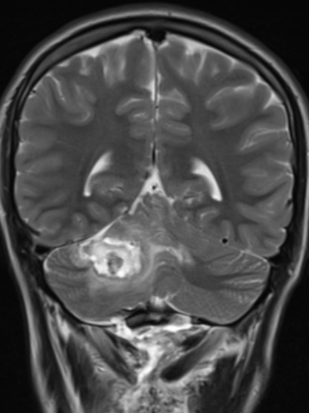 Jake L. stage 4 ALK-positive lung cancer