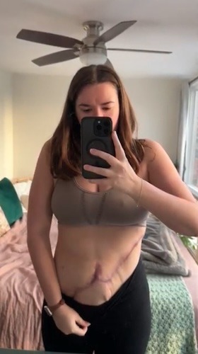 Katie L. alveolar soft part sarcoma