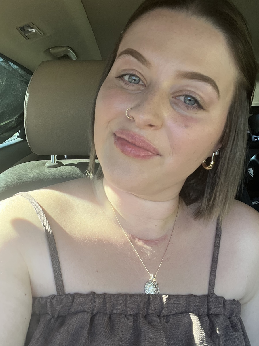 Jessica S. Burkitt lymphoma