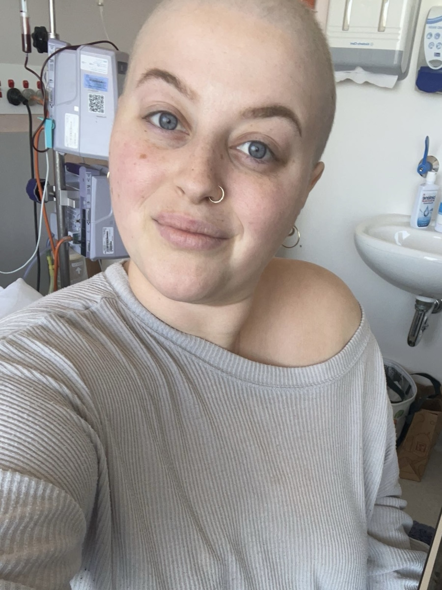 Jessica S. Burkitt lymphoma