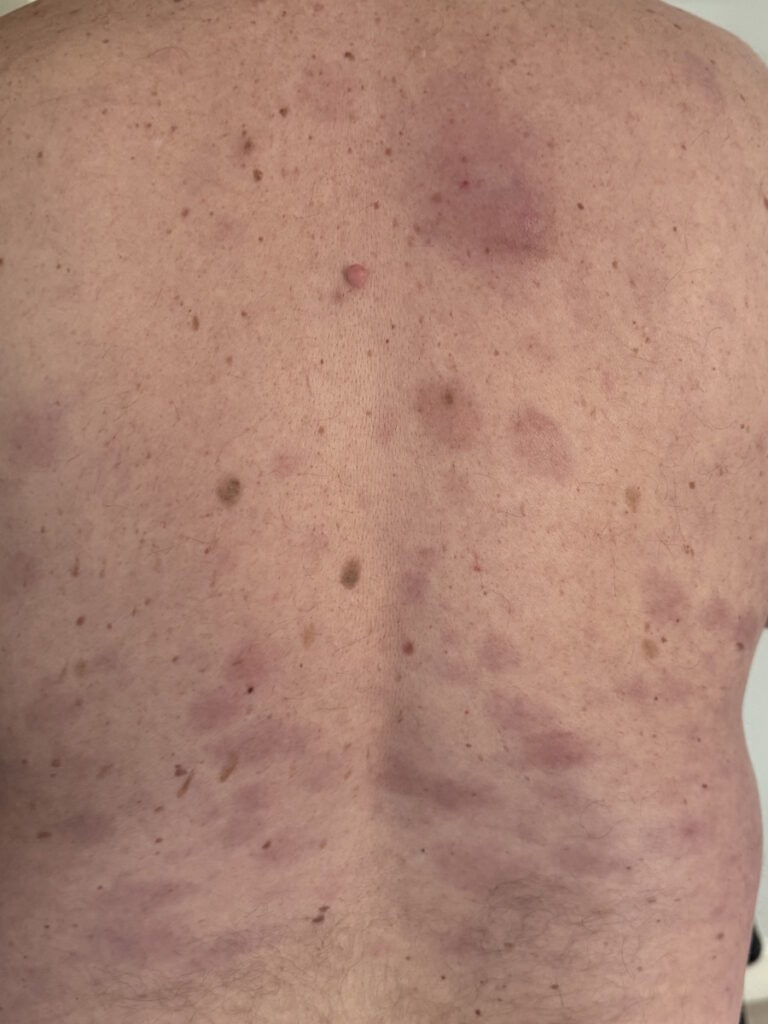 Jim T. BPDCN rash