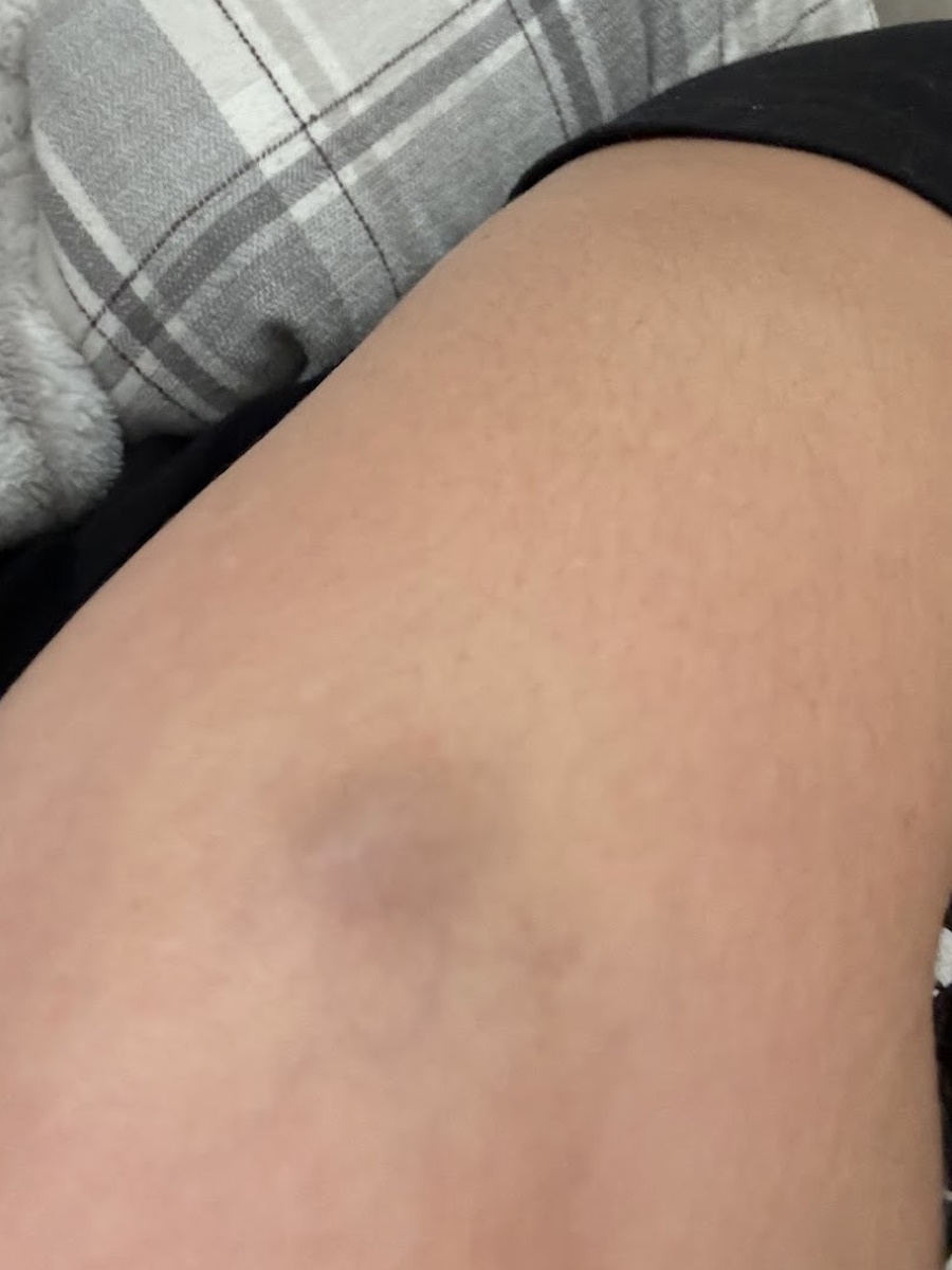 Marie R. stage 3C melanoma