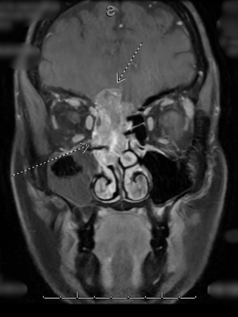 Sian M. neuroendocrine carcinoma