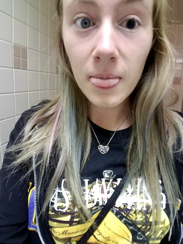 Alicia M. ocular melanoma