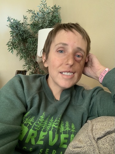 Amanda R. DCIS breast cancer and osteosarcoma
