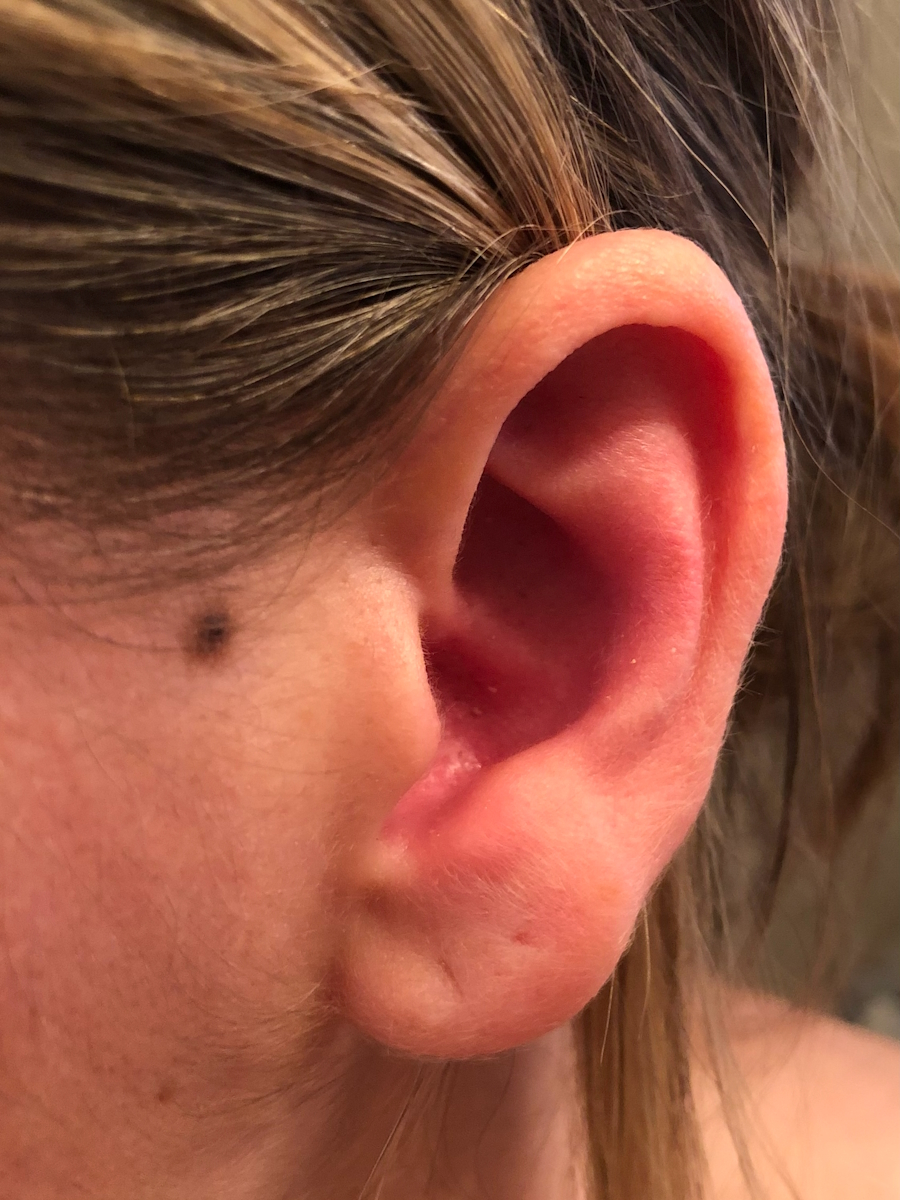 Cheryl M. stage 1A melanoma