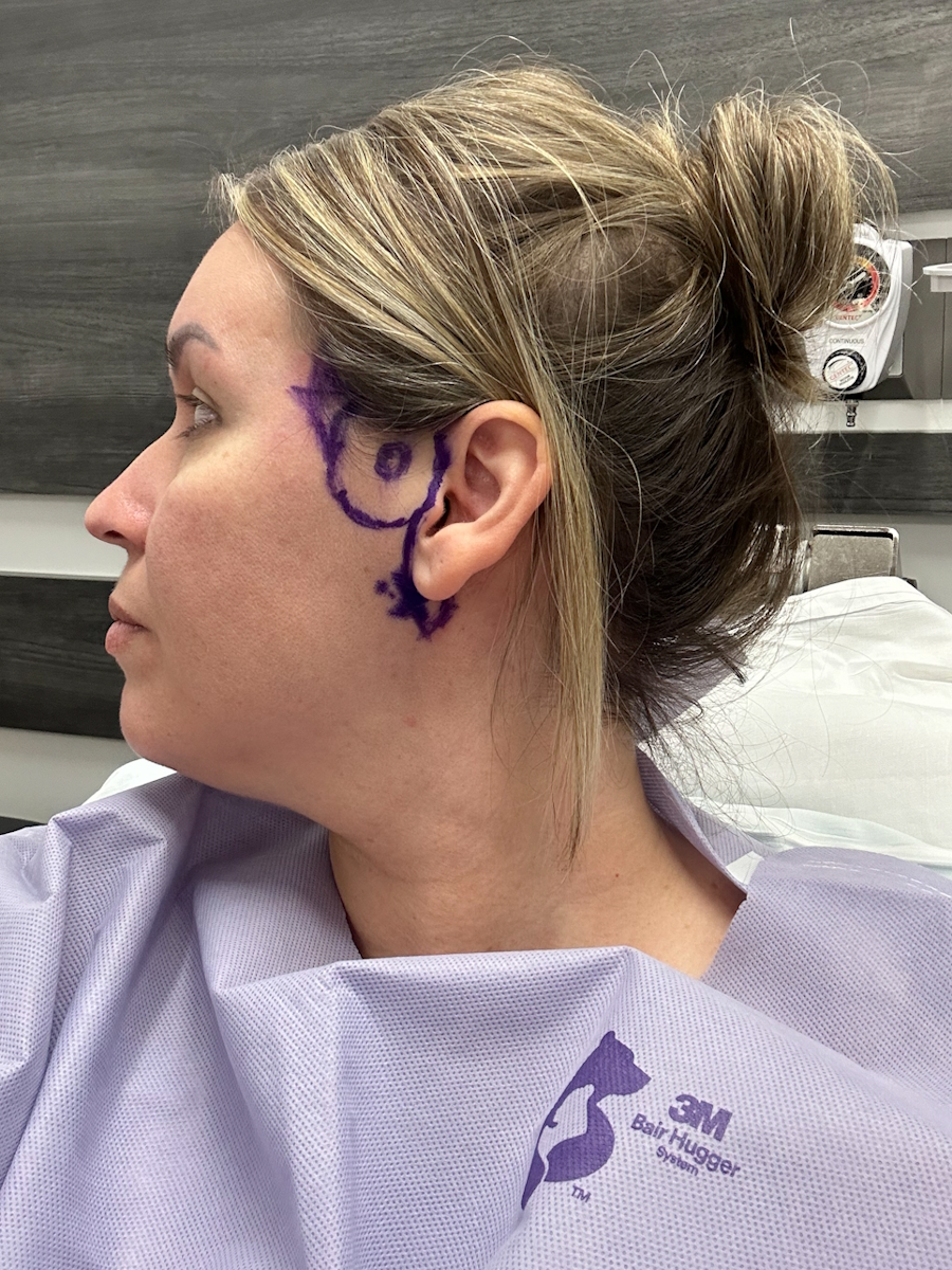 Cheryl M. stage 1A melanoma