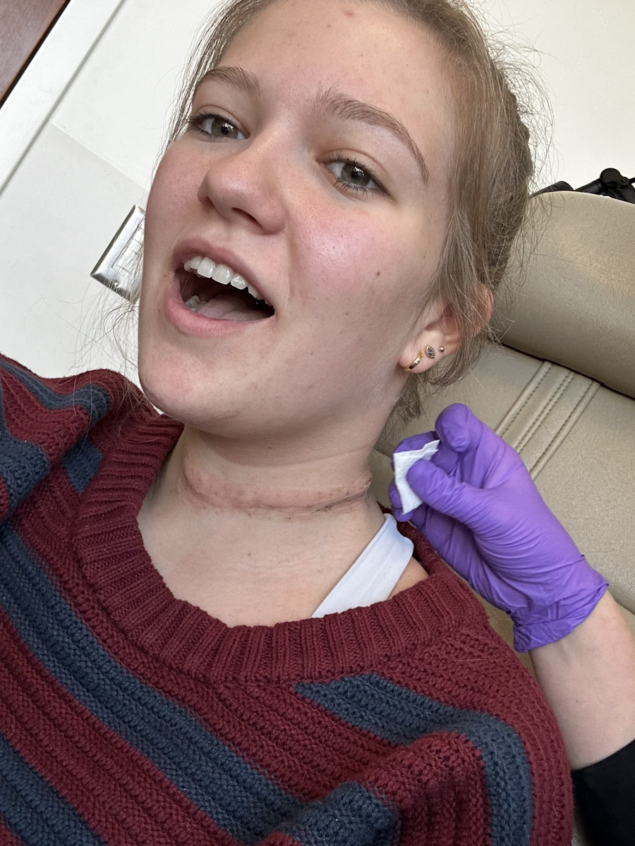 Jess H. papillary thyroid cancer