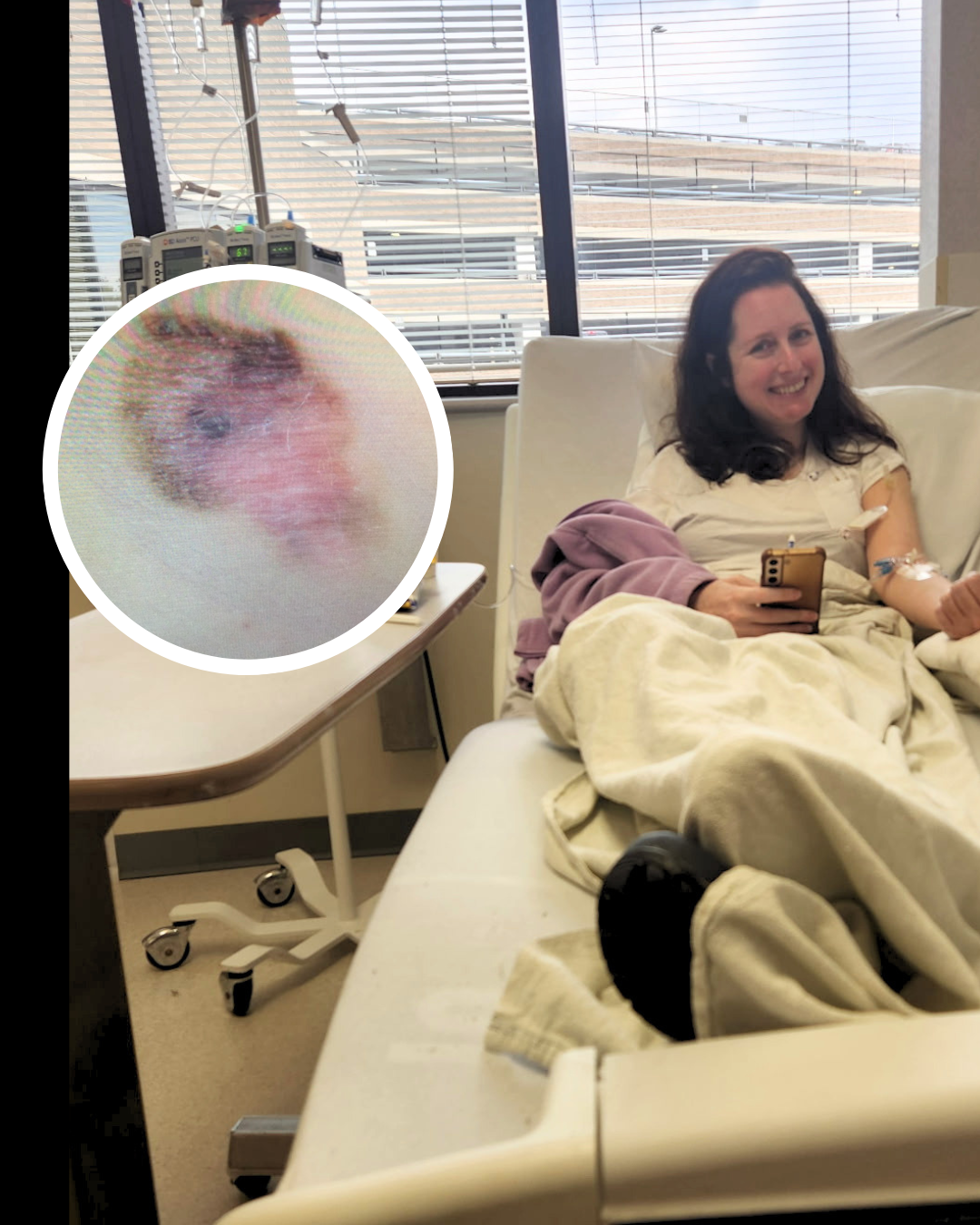 Megan C. stage 4 melanoma mole and treatment