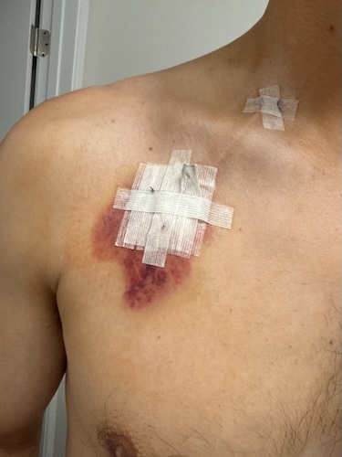Tyler L. thymic carcinoma